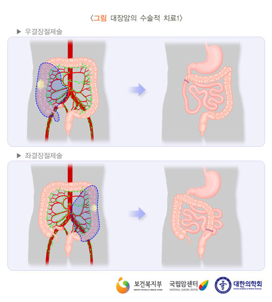 [그림: 대장암의 수술적 치료1] 우결장절제술, 좌결장절제술(출처: 보건복지부, 국립암센터, 대한의학회)