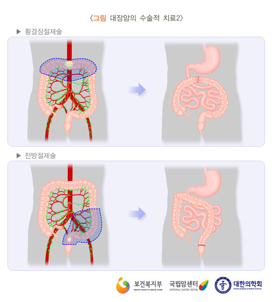 [그림: 대장암의 수술적 치료2] 횡결장절제술, 전방절제술(출처: 보건복지부, 국립암센터, 대한의학회)