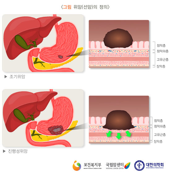 [그림: 위암(선암)의 정의] 조기위암: 암덩이가 점막층에 위치/ 진행성위암: 암덩이가 점막하층으로 퍼지고 있다.(출처: 보건복지부, 국립암센터, 대한의학회)