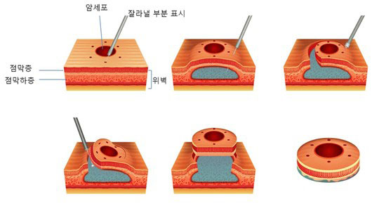내시경적 점막하박리술 이미지