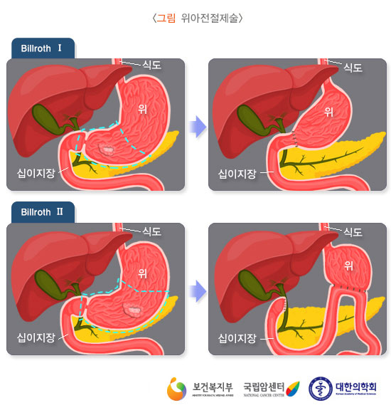 [그림: 위아전절제술] 출처: 보건복지부, 국립암센터, 대한의학회