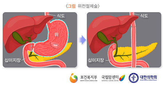 [그림: 위전절제술] 출처: 보건복지부, 국립암센터, 대한의학회