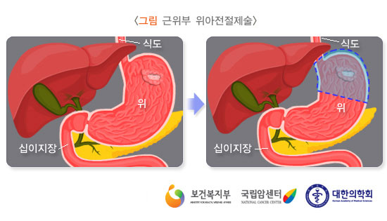 [그림: 근위부 위아전절제술] 출처: 보건복지부, 국립암센터, 대한의학회