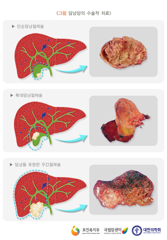 [그림: 담낭암의 수술적 치료] 단순담낭절제술, 확대담낭절제술, 담낭을 포함한 우간절제술 (출처: 보건복지부, 국립암센터, 대한의학회)