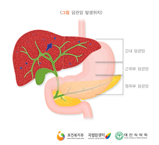 [그림: 담관암 발생위치]간내 담관암, 근위부 담관암, 원위부 담관암(출처: 보건복지부, 국립암센터, 대한의학회) 