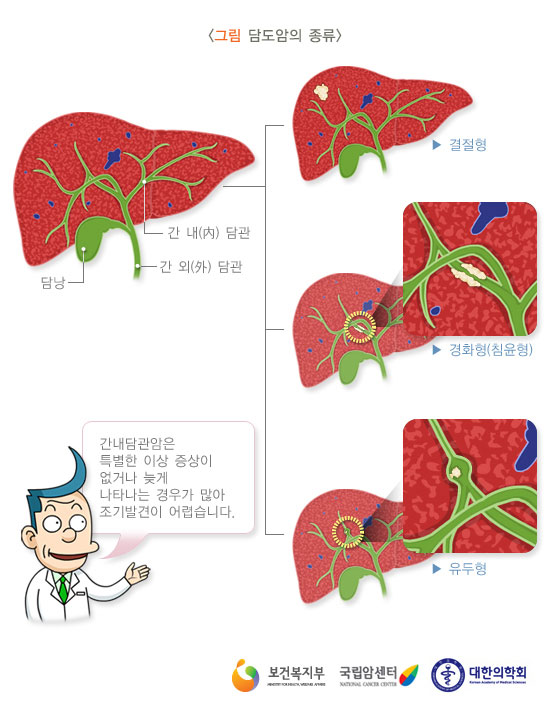 [그림: 담도암의 종류]결절형, 경화형(침윤형), 유두형, 간내담관암은 특별한 증상이 없거나 늦게 나타는 경우가 많아 조기 발견이 어렵습니다.(출처: 보건복지부, 국립암센터, 대한의학회)