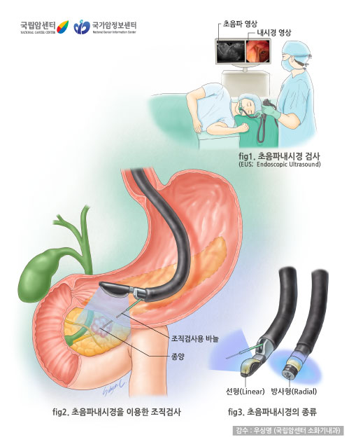 [그림: 내시경초음파] 초음파내시경검사:초음파영상, 내시경영상 / 초음파내시경을 이용한 조직검사:조직검사용 바늘을 이용해 종양을 채취 / 초음파내시경의 종류: 선형, 방사형