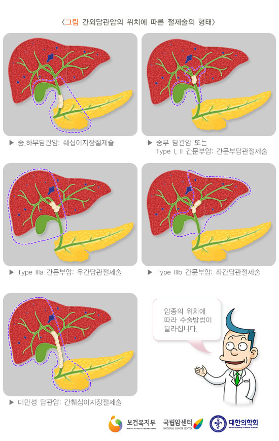 [그림: 간외담관암의 위치에 따른 절제술의 형태]