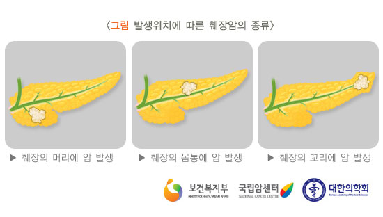 [그림: 발생위치에 따른 췌장암의 종류] 췌장의 머리에 암 발생, 췌장의 몸통에 암 발생, 췌장의 꼬리에 암 발생(출처: 보건복지부, 국립암센터, 대한의학회)