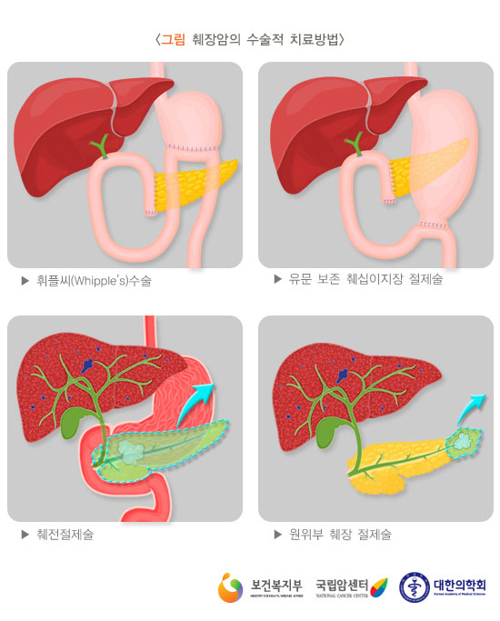 [그림: 췌장암의 수술적 치료방법]휘플씨 수술, 유문보존췌십이지장 절제술, 췌전절제술,원위부 췌장 절제술(출처: 보건복지부, 구립암센터, 대한의학회)
