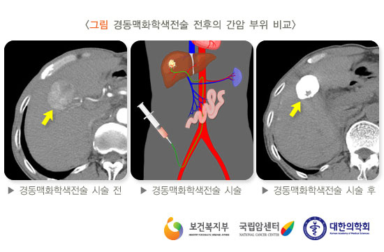 [그림 경동맥화학색전술 전후의 간암 부위 비교] 시술 전, 시술, 시술 후