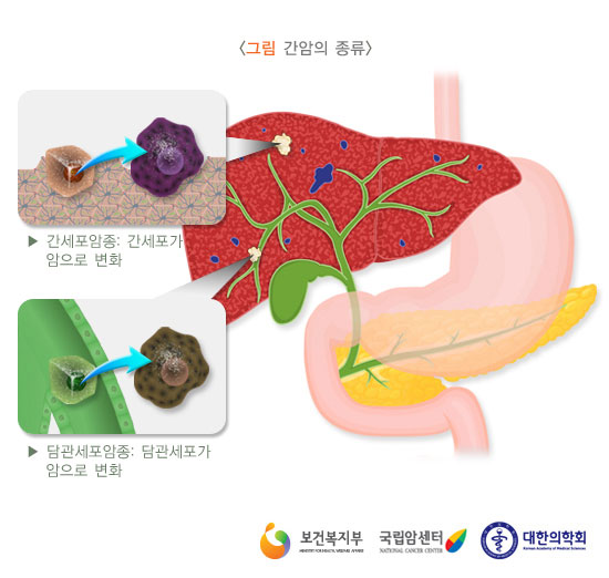 [그림 간암의 종류] 간세포암종: 간세포가 암으로 변화 / 담관세포암종: 담관세포가 암으로 변화 < 출처: 보건복지부, 국립암센터, 대한의학회 >