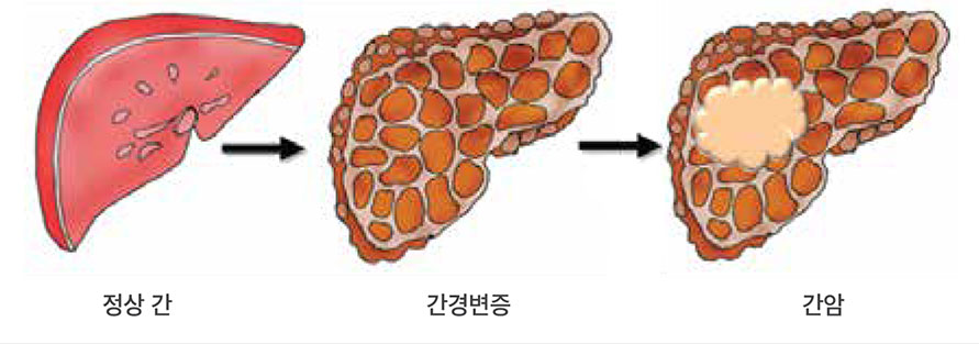정상간과 간경변증, 간암의 모양