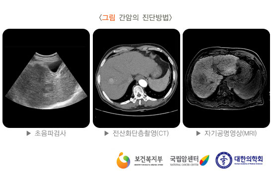 [그림 간암의 진단법] 초음파검사, 전산화단층촬영(CT), 자기공명영상(MRI)