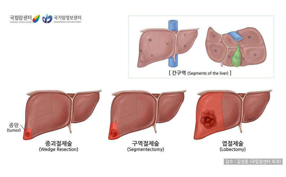 간구역(Segments of the liver) 과 종괴절제술(Wedge Resection), 구역절제술(Segmentectomy)엽절제술(Lobectomy),