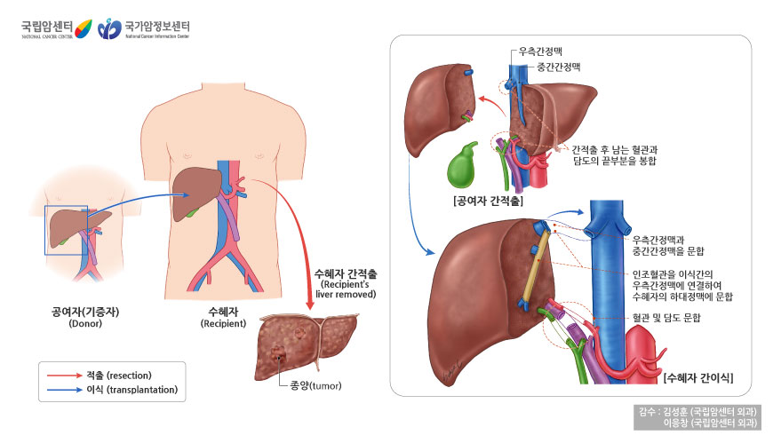 수혜자의 간을 적출해서 공여자의 간을 이식. 공여자의 간을 적출 후 남는 혈관과 담도의끝부분을 봉합, 수혜자의 우측간정맥과 중간 정맥을 문합하고 인조혈관을 이식간의 우측간 정맥에 연결하여 수혜자의 하대정매에 문합, 혈관 및 담도 문합