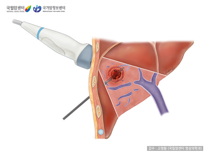 고주파 열 치료술 이미지