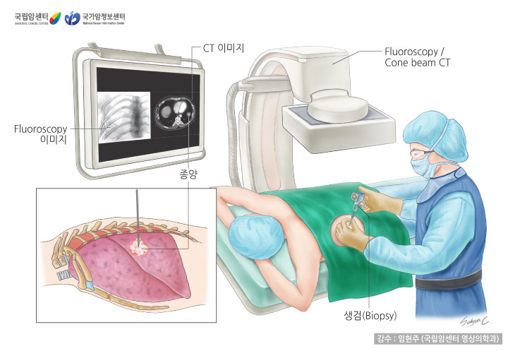 Fluoroscopy 이미지, CT 이미지, 종양, Fluoroscopy.Cone beam CT, 생검(Biopsy) 이미지 (출처: 국립암센터, 국가암정보센터)