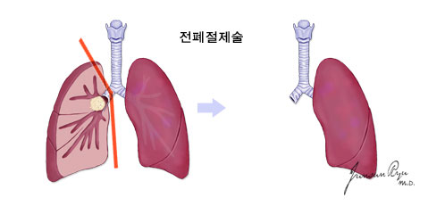 양업절제술 이미지