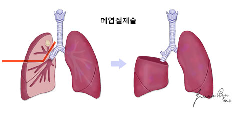 쐐기절제술 이미지