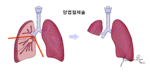 폐엽절제술 이미지
