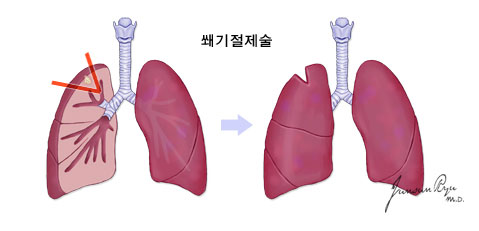 전폐절제술 이미지