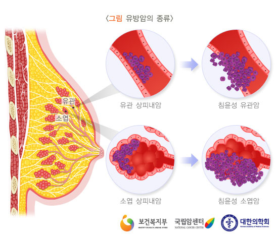 [그림: 유방암의 종류] 유관 상피내암, 침윤성 유관암, 소엽 상피내암, 침윤성 소엽암 (출처: 보건복지부, 국립암센터, 대한의학회)