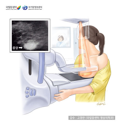 유방촬영술 이미지 (감수: 고경란, 국립암센터 영상의학과 / 출처: 국립암센터, 국가암정보센터)