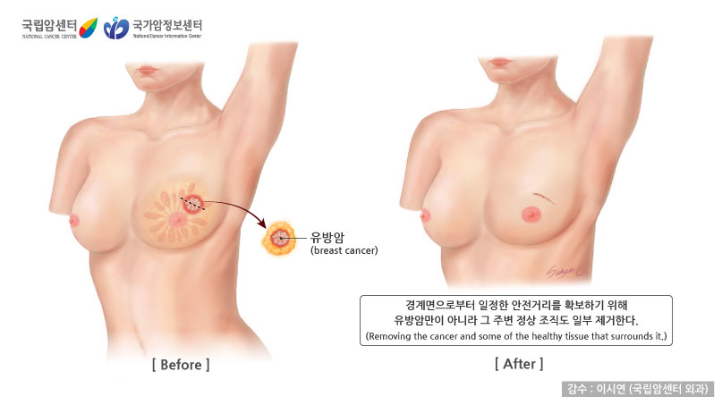 경계면으로부터 일정한 안전거리를 확보하기 위해 유방암만이 아니라 그 주변 정상 조직도 일부 제거한다. (감수: 이시연(국림암센터 외과) / 출처: 국립암센터, 국가암정보센터)