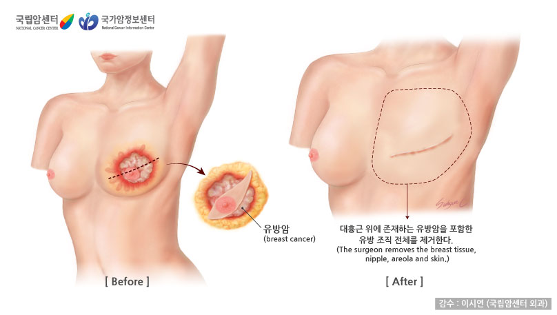 대흉근 위에 존재하는 유방암을 포함한 유방 조직 전체를 제거한다. (감수: 이시연(국림암센터 외과) / 출처: 국립암센터, 국가암정보센터)