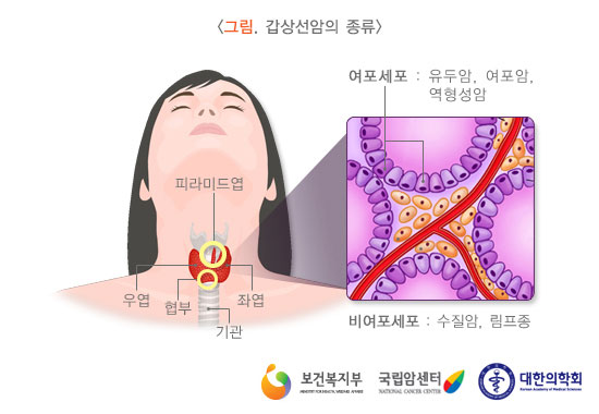 [그림: 갑상선압의 종류] 여포세포: 유두암, 여포암, 역행성암 / 비여포세포: 수질암, 림프종 (피라미드엽, 우엽, 좌엽, 형부, 기관)