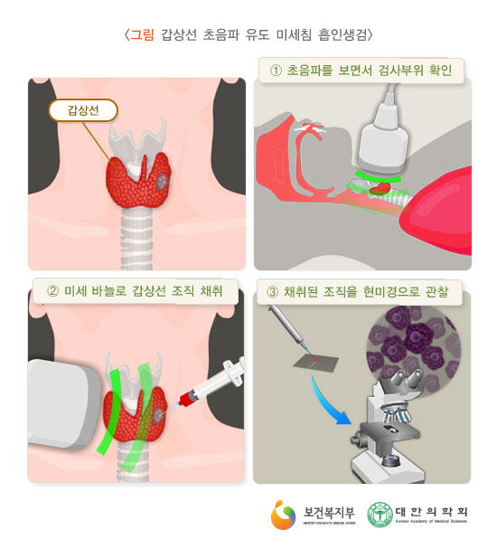 [그림: 갑상선 초음파 유도 미세침 흡인생검]