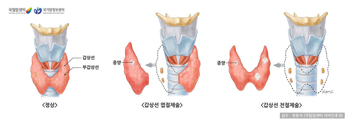 정상, 갑상선 엽절제술, 갑상선 전절제술 (감수: 정유석(국림암센터 이비인후과) / 출처: 국립암센터, 국가암정보센터)