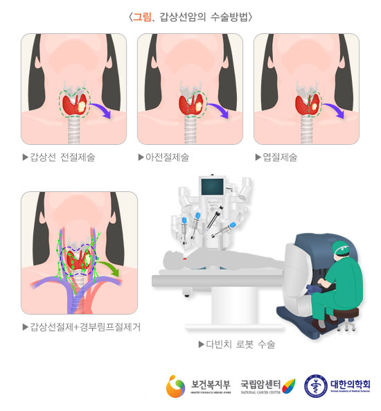 [그림: 갑상선암의 수술방법] 갑상선 전절제술, 아전절제술, 엽절제술, 갑상선절제+경부림프절제거, 다빈치 로봇 수술 (출처: 보건복지부, 국립암센터, 대한의학회)