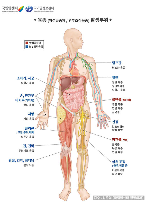 육종 발생부위로는 악성골종양에는 골반골,장관골이 있고 연부조직육종에는 소화기, 자궁, 손, 전완부, 대퇴부, 지방, 골격근, 건, 건막, 관절, 건막, 점액낭, 림프관, 혈관, 신경, 섬유조직 등이 있다.
