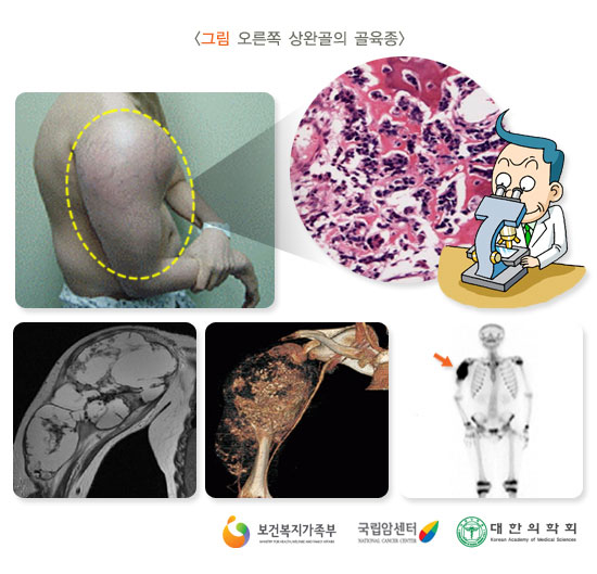 [그림: 오른쪽 상완골 골육종]출처: 보건복지부, 국립암센터, 대한의학회