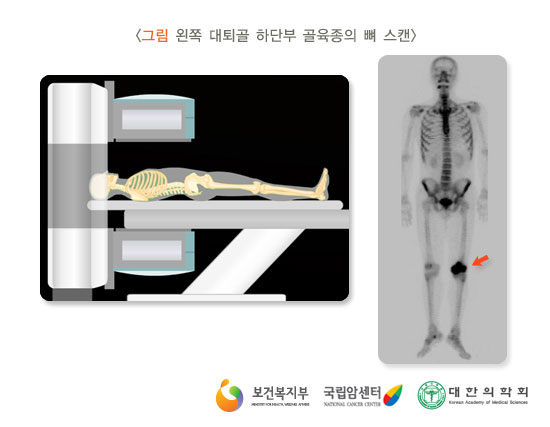 [그림: 왼쪽 대퇴골 하단부 골육종의 뼈 스캔] 출처: 보건복지부, 국립암센터, 대한의학회