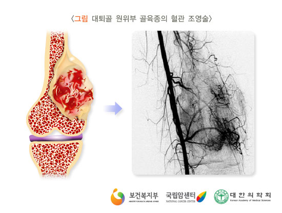 [그림: 대퇴골 원위부 골육종의 혈관 조영술] 출처: 보건복지부, 국립암센터, 대한의학회