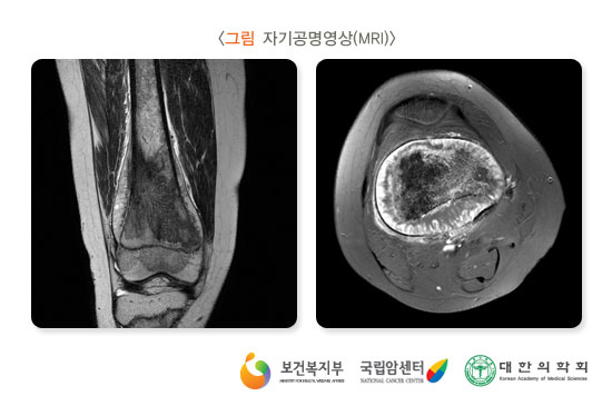 [그림: 가지공명영상(MRI)] 출처: 보건복지부, 국립암센터, 대한의학회