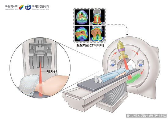 토모치료(출처: 국립암센터, 국가암정보센터)