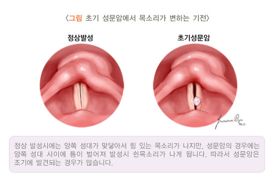 [그림: 초기 성문암에서 목소리가 변하는 기전] 정상발성, 초기성문암
