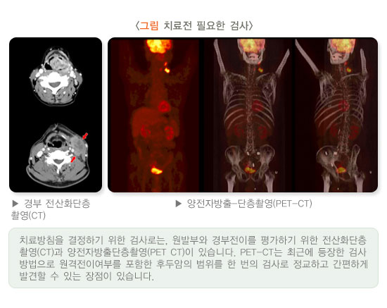 [그림: 치료전 필요한 검사]경부 전산화단층촬영(CT), 양전자방출-단층촬영(PET-CT)