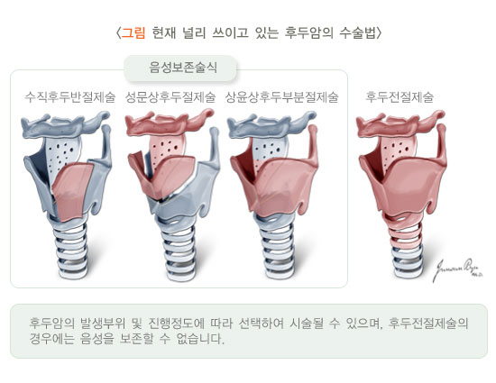 음성보존술식: 수직후두반절제술, 성문상후두절제술, 상윤상후부분절제술 / 후두전절제술