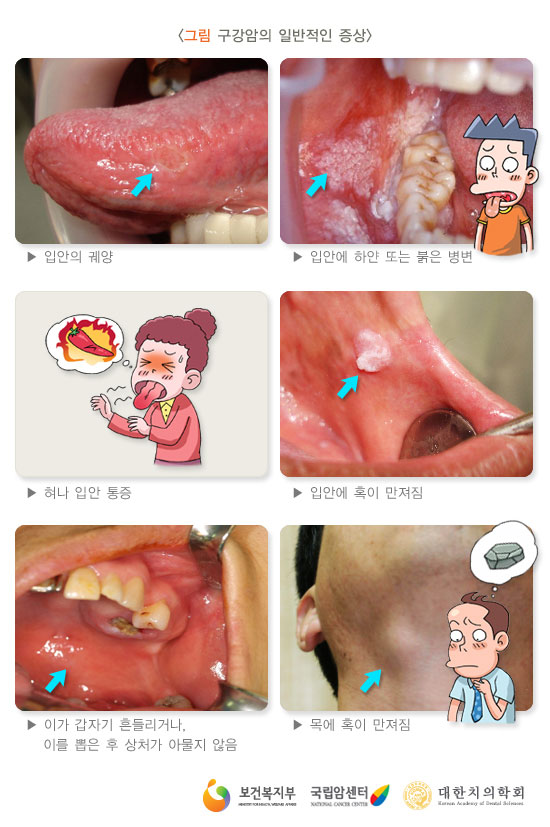 [그림: 구강암의 일반적인 증상](출처: 보건복지부, 국립암센터, 대한치의학회)