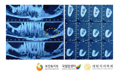 전산화단층촬영(출처: 국가암정보센터)