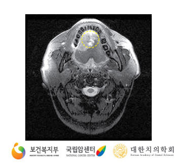 자기공명영상(출처: 국가암정보센터)