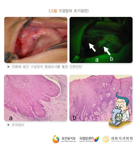[그림: 구강암의 조기검진]잇몸에 생긴 구강암의 형광조사를 통한 간편진단,조직검사(출처: 보건복지부, 국립암센터, 대한치의학회)