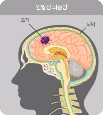 원발성뇌종양