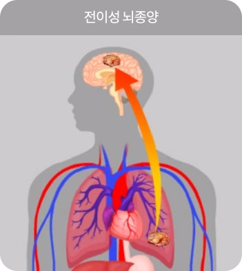전이성 뇌종양
