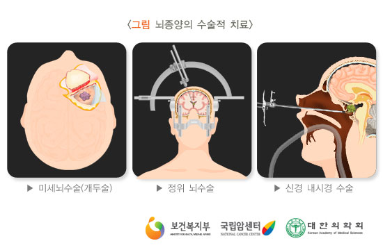 [그림: 뇌종양의 수술적 치료]미세뇌수술(개두술), 정위 뇌수술, 신경 내시경수술(출처: 보건복지부, 국립암센터, 대한의학회)